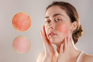 Someone with rosacea on their cheeks.