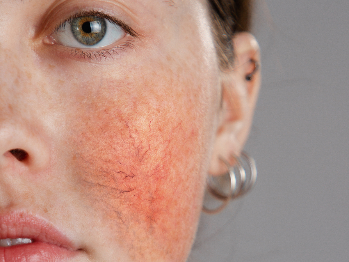 Woman with rosacea on her cheek