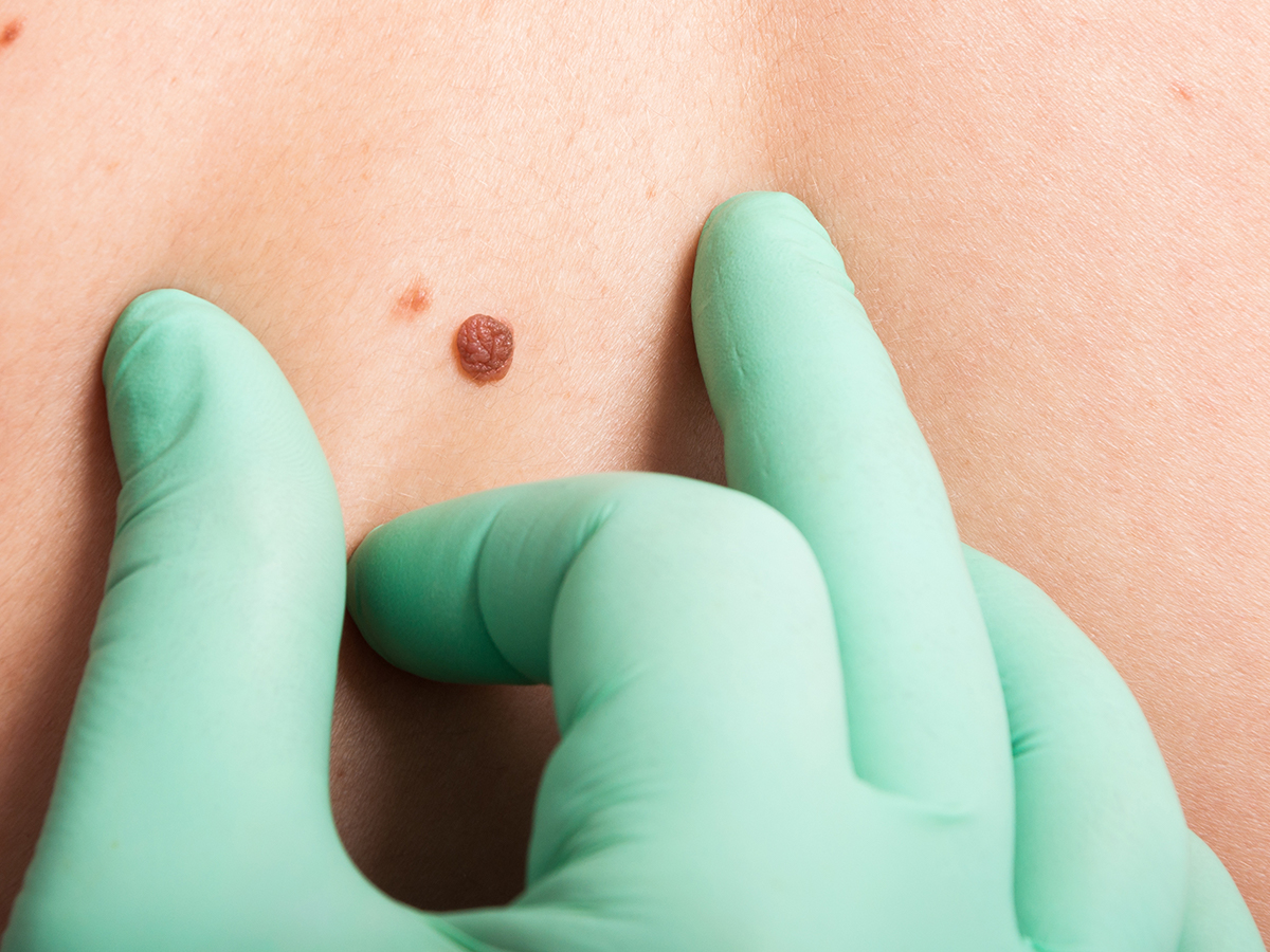 Dermatologist checking mole
