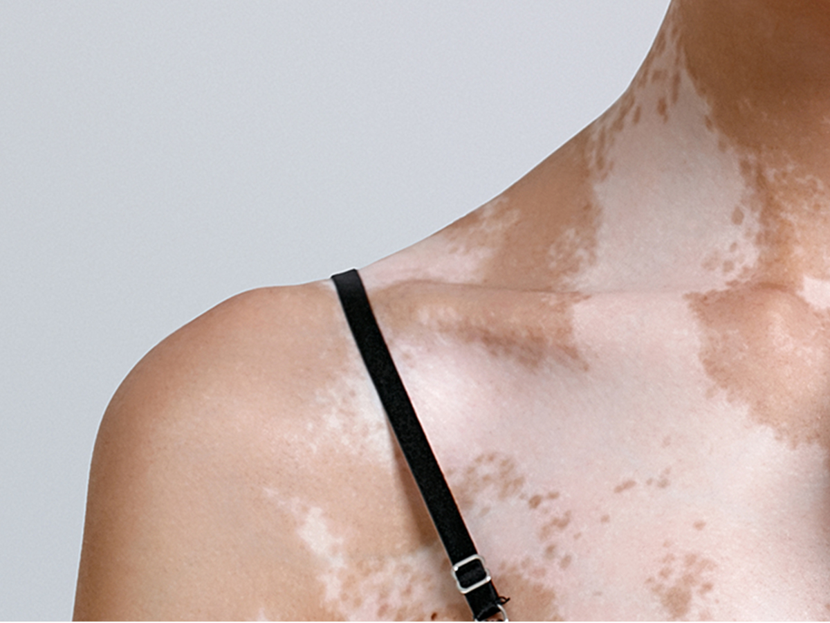 Woman with vitiligo on her shoulder