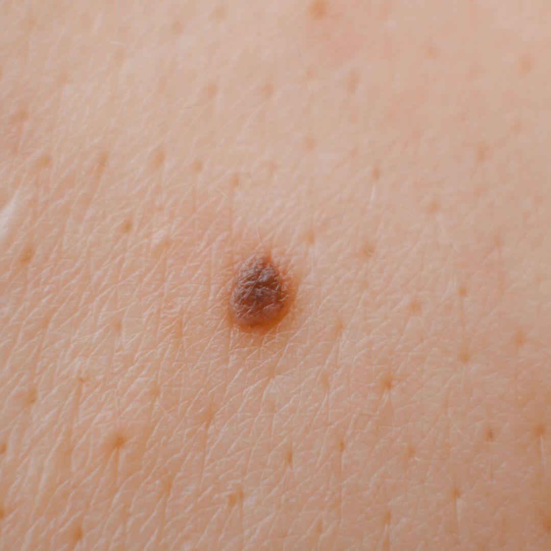 picture of an asymmetrical mole on skin