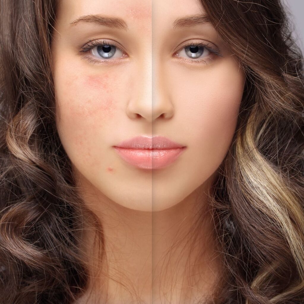 skin before and after microdermabrasion