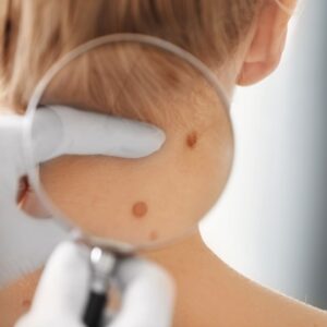 dermatologist looking at neck freckle