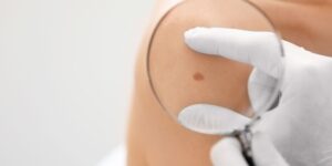 mohs skin surgery consult
