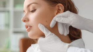 skin cancer check up