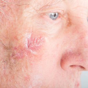 minimal scar on face