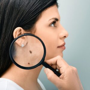 looking at skin cancer on face