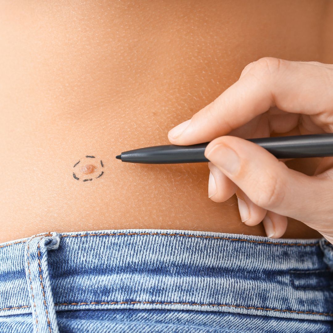 Circling an area of concern on patient's back