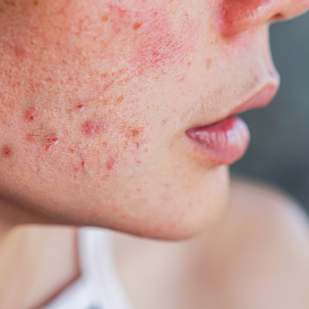 image of a woman with acne