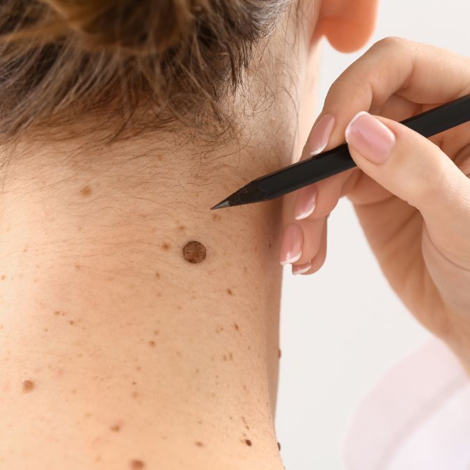 Physician marking a mole on a patient's neck