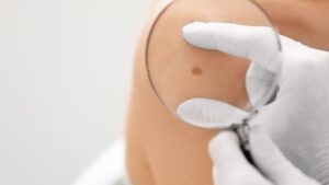 a dermatologist magnifying a mole
