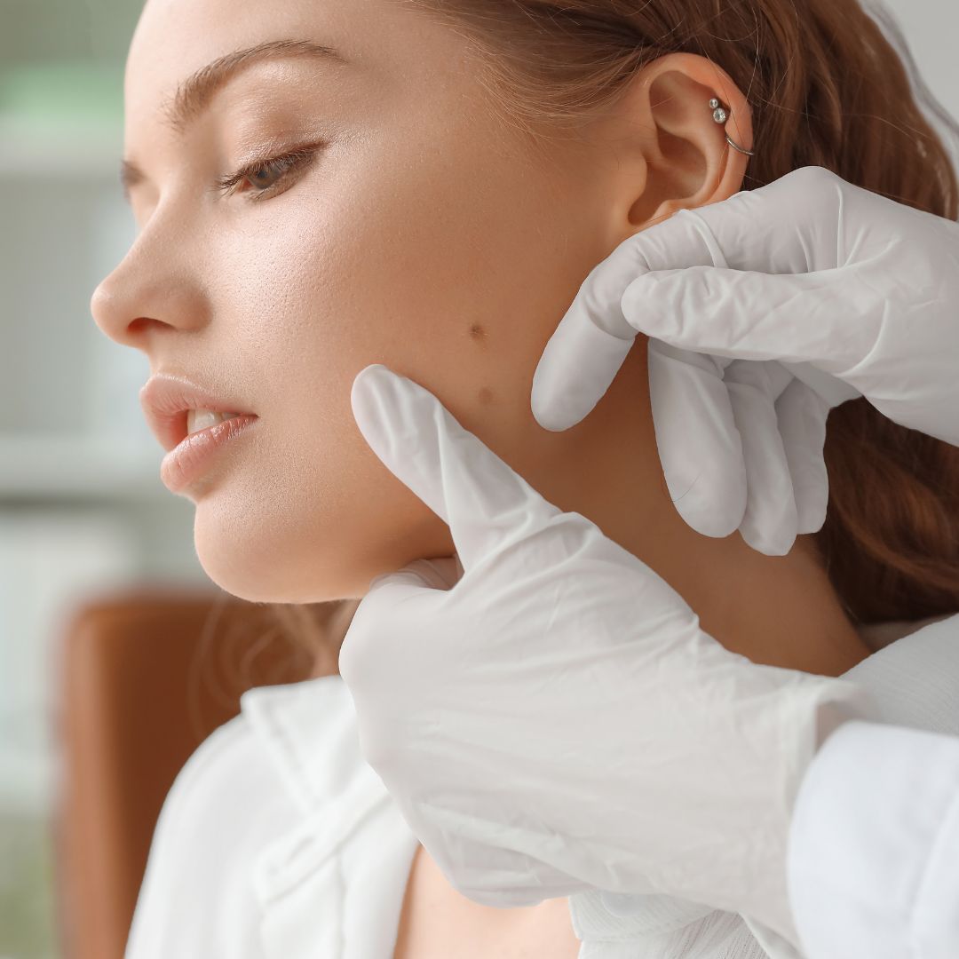 dermatologist checking a mole on a woman's face