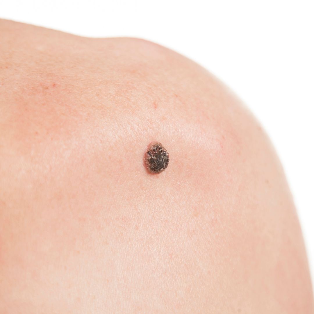 Squamous Cell Carcinoma