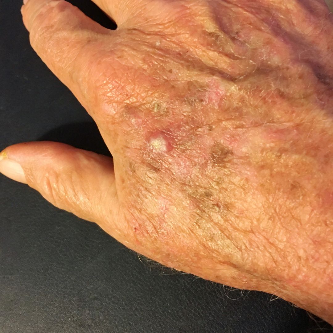 Actinic Keratosis 