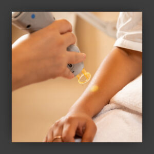 arm hair laser hair removal