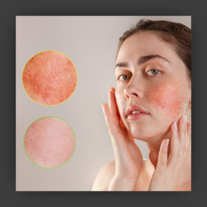 Before and after look at a woman who received rosacea treatment