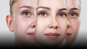 Before and after acne treatment