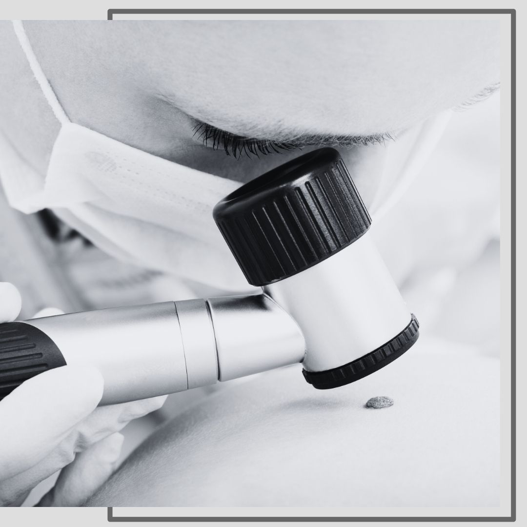 mole examination