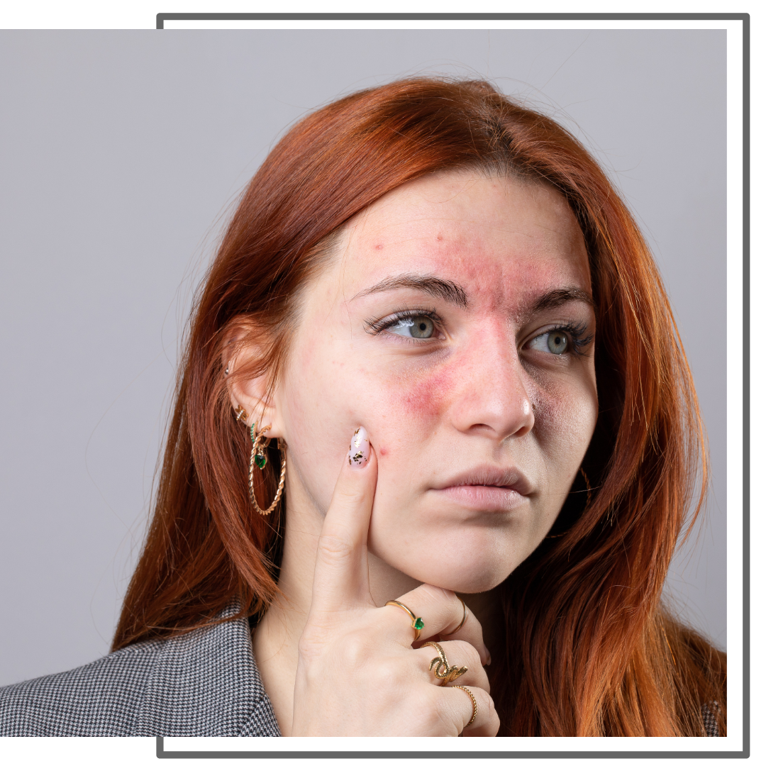 Rosacea 1