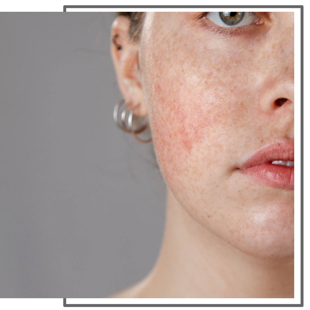 Rosacea 2