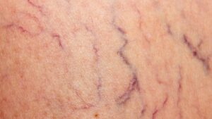 up close view of spider veins