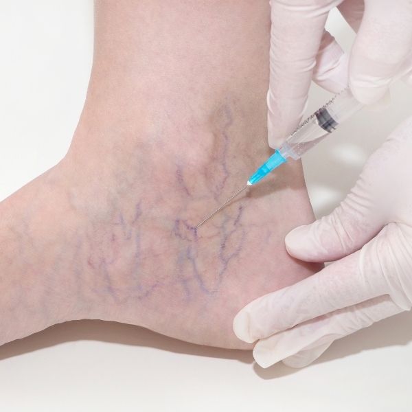 injecting spider veins to treat them